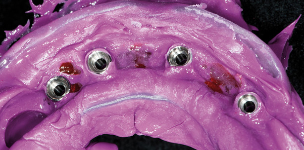 Restauration mittels DVT und CAD/CAM