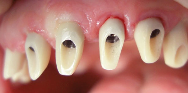Modified clinical approach for improved aesthetics in full-arch restoration