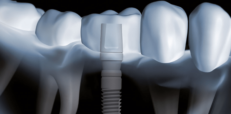 Investoren für patentiertes Zahnimplantat gesucht