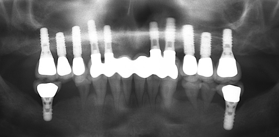 Inoperabler Nasen-Rachentumor bei einem Kleinkind
