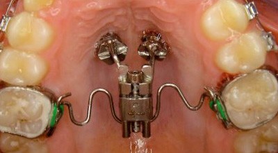 Grundlagen der Insertion