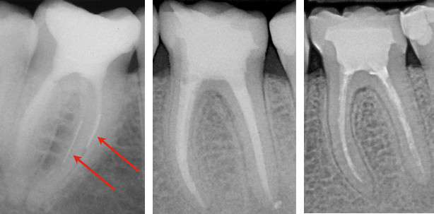 Reziproke Aufbereitung – Ist die Zeit der Instrumentenbrüche vorbei?