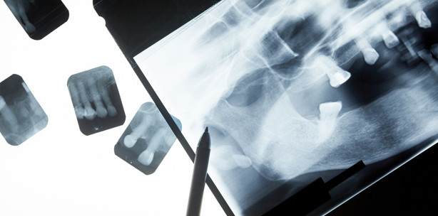 Intra-oral-welding ermöglicht Implantation an einem Tag