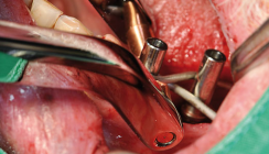 Minimalinvasive Implantatprothetik – „Punktschweißen im Mund“