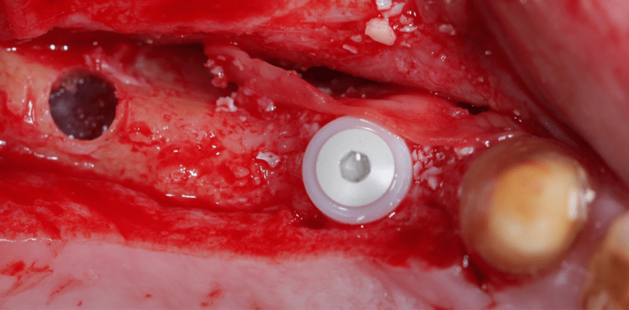 Orale Ultraschallchirurgie