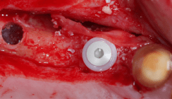 Orale Ultraschallchirurgie