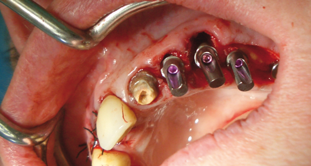Hydrodynamische Sinusbodenelevation