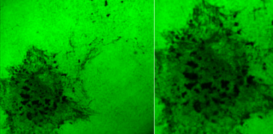 Warum metastasiert Mundkrebs?