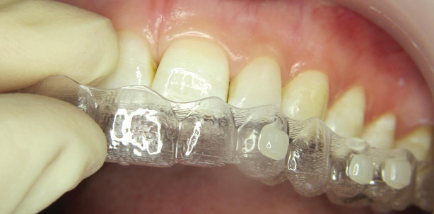 Herstellung patientenindividueller Invisalign®-Attachments mit SDR