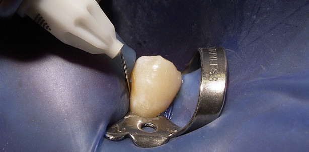 Differenzialdiagnose unklarer irradiierender pulpitischer Schmerzen