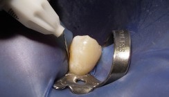 Differenzialdiagnose unklarer irradiierender pulpitischer Schmerzen