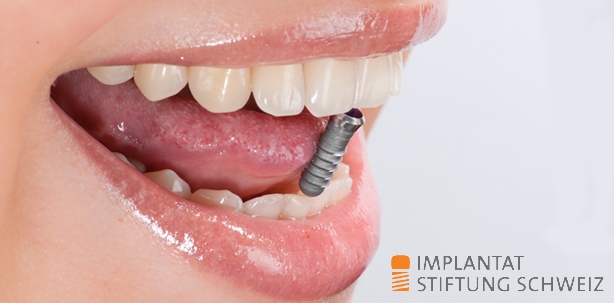 Sieben Jahre Implantat Stiftung Schweiz: eine Erfolgsgeschichte!
