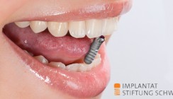 Sieben Jahre Implantat Stiftung Schweiz: eine Erfolgsgeschichte!