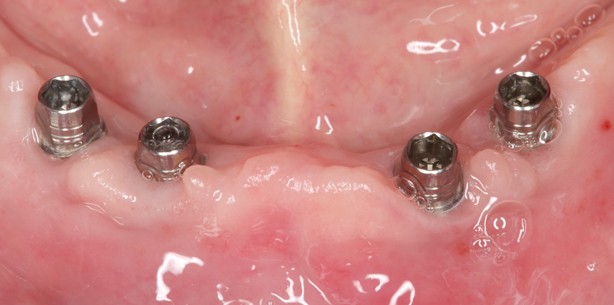 Implantatgetragene Prothese zur Versorgung zahnloser Kiefer