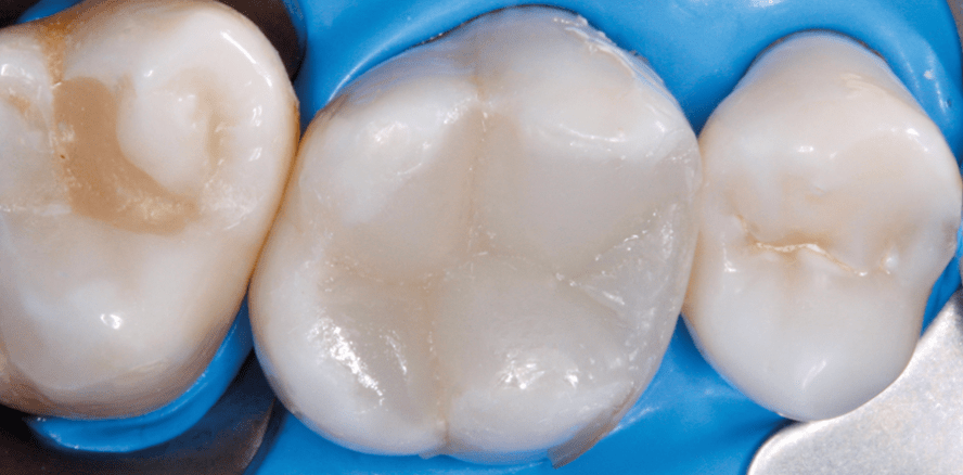 Moderne direkte Füllungstechnik im Seitenzahnbereich