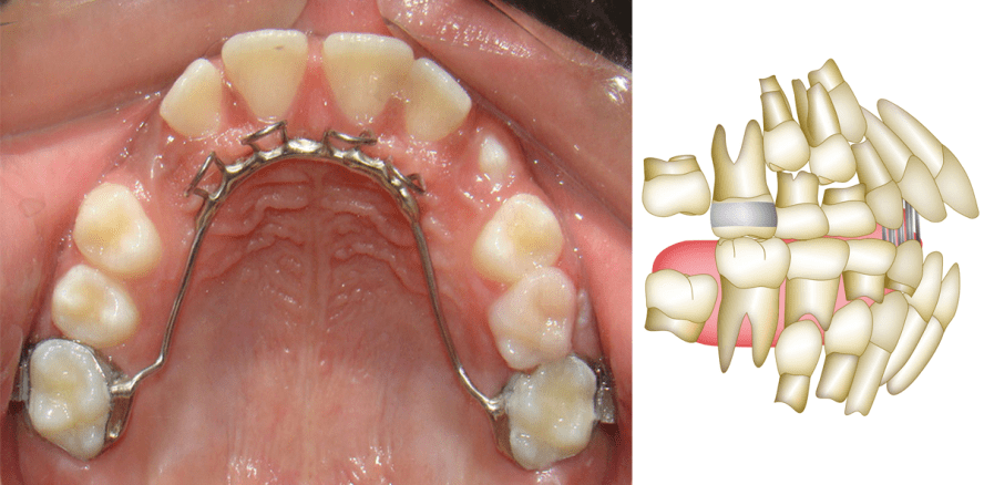 Mechanische Strategien zur Verbesserung der Behandlungsstabilität offener Bisse
