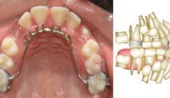 Mechanische Strategien zur Verbesserung der Behandlungsstabilität offener Bisse