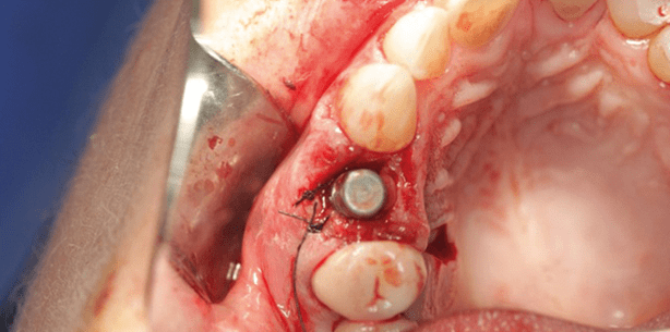 Sofortimplantation ohne Auffüllen der Jumping Distances