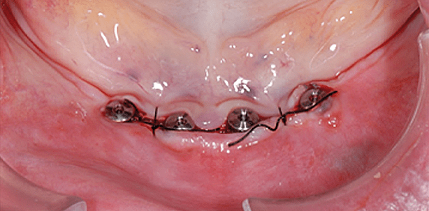 Herausforderungen der Implantatversorgung bei alternden Patienten