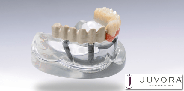 Einsatz für Hochleistungspolymere: Digitale CAD/CAM-Technologie für moderne Zahnmedizin