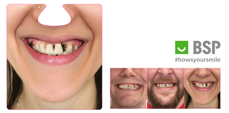 Mit Horrorvideos zu mehr Aufmerksamkeit für parodontale Gesundheit