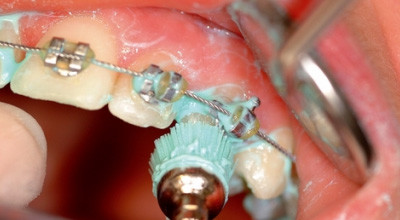 Kampf dem bakteriellen Biofilm