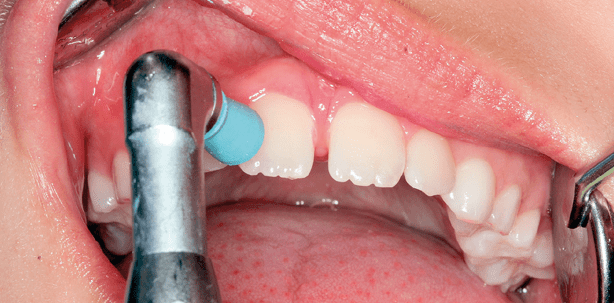 Kariesprävention bei Kindern – individuelle Konzepte