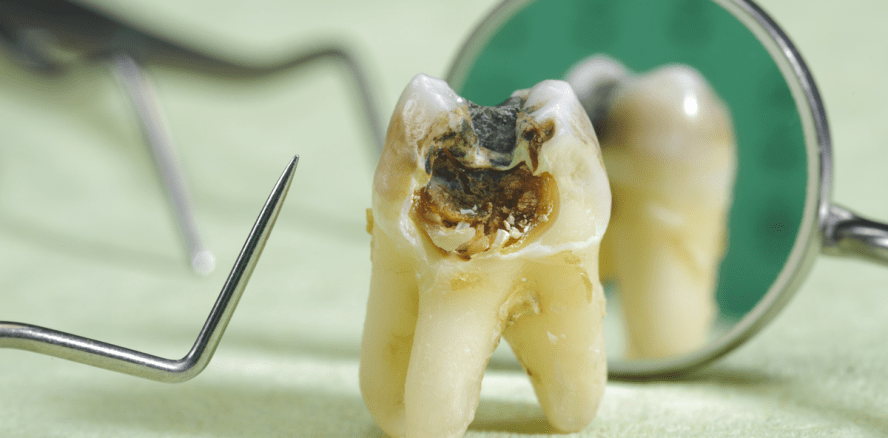 Forscher suchen nach neuen Methoden im Kampf gegen Karies