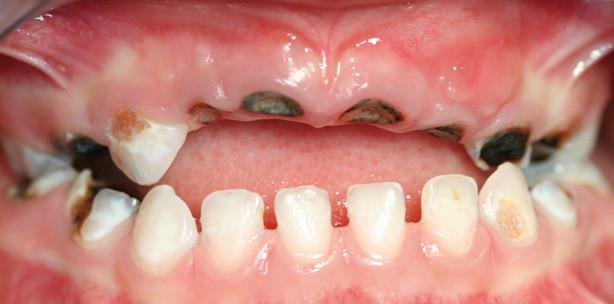 Diagnose des Kariesrisikos – Was mache ich wann in der Praxis?