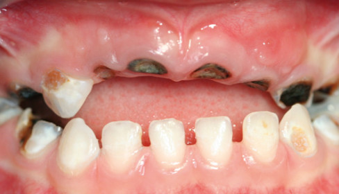 Kariesdiagnostik ohne ionisierende Röntgenstrahlung – ZWP online – das ...