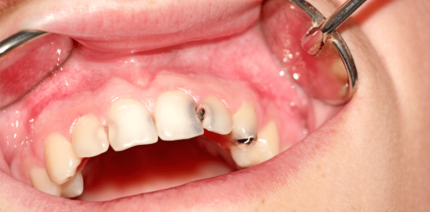 Neue S2k-Leitlinie „Kariesprophylaxe bei bleibenden Zähnen“