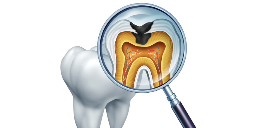 Fast jeder Filipino leidet unter Karies