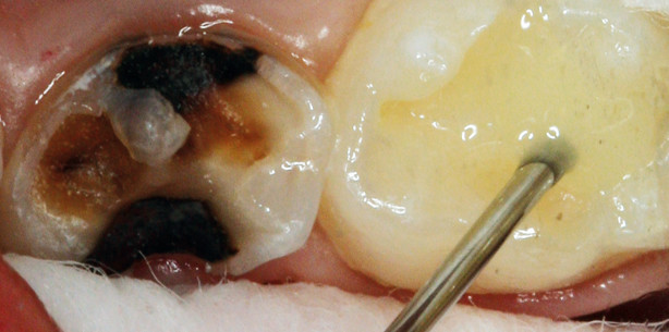 Kinderzahnheilkunde – schneller und stressfreier