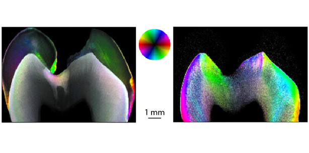 Mit Nanoforschung der Karies auf der Spur