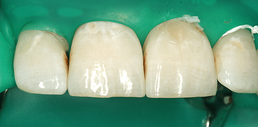 Mikroinvasivität durch Kariesinfiltration