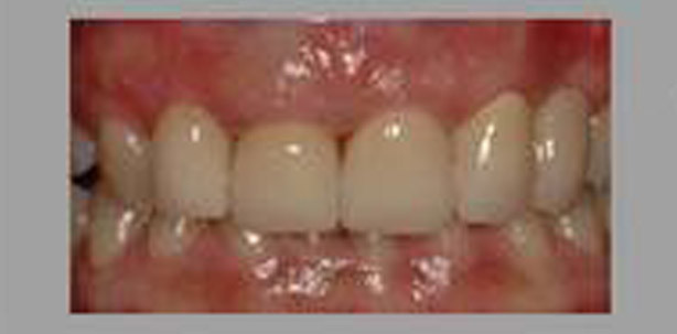 Katana Zirkon (transluzent) im Seiten- als auch im Frontzahnbereich