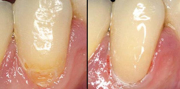 Effiziente Versorgung einer Klasse V-Kavität