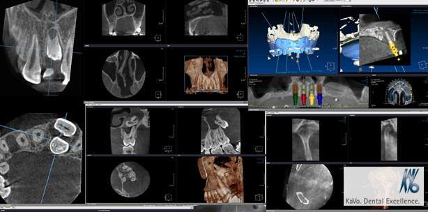 Webinar: DVT-Aufnahmen problemlos auswerten