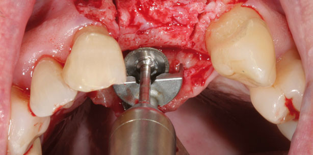 Besonders patientenfreundliche Distraktion
