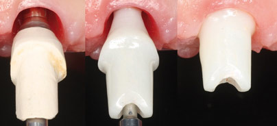 Ästhetische Versorgung mit Keramik