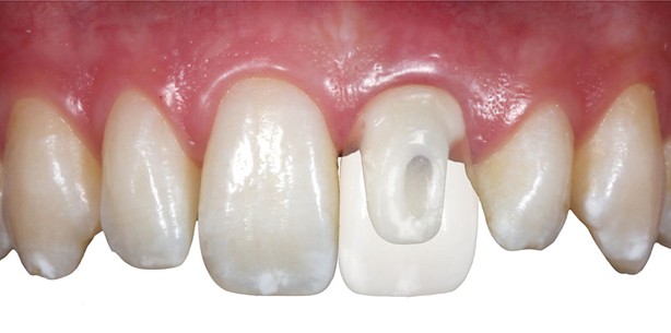 Vollkeramische Abutments in der Implantatprothetik: Einteilig oder zweiteilig?