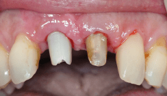 Keramikimplantate – Möglichkeiten und Grenzen