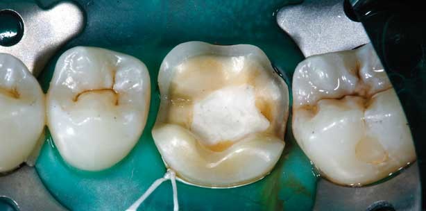 Reduzierte Mindestschichtstärken