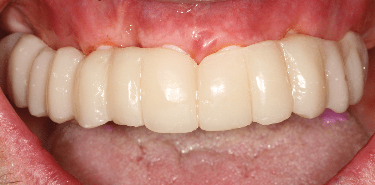 Sofort- und Spätimplantate aus Keramik in Kombination