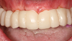 Sofort- und Spätimplantate aus Keramik in Kombination