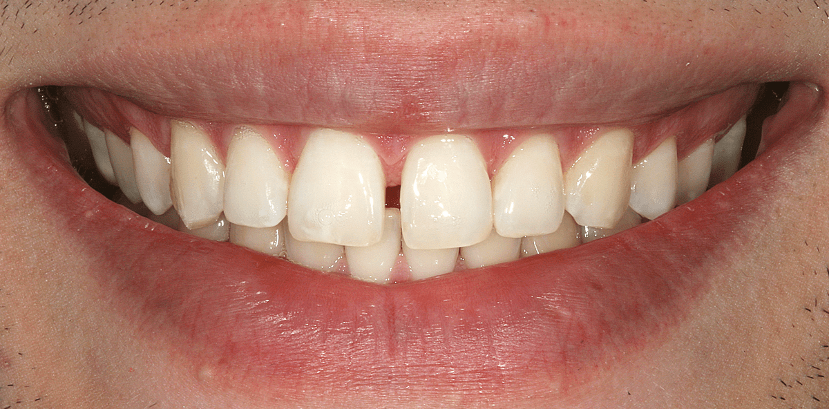 Minimalinvasive Veneer-Versorgung mit keramisch basiertem Füllungsmaterial