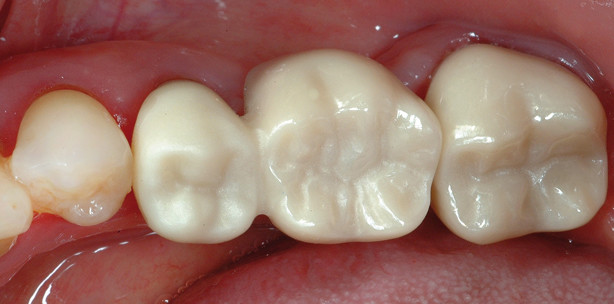 „Vollzirkon“ – eine prospektive Versorgung?