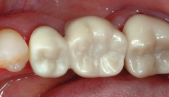 „Vollzirkon“ – eine prospektive Versorgung?