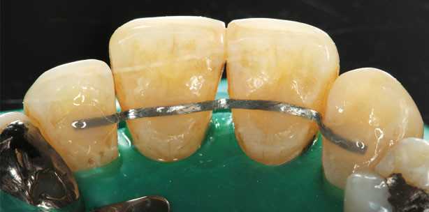 Hilfselemente in der Kieferorthopädie und deren Abrechnung