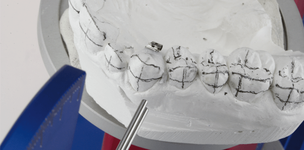 Individuelle Einzelzahnsteuerung bei lingualen Apparaturen